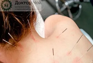 История иглоукалывания