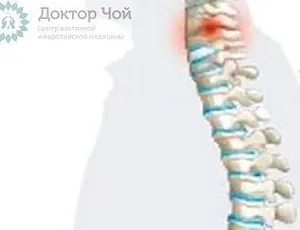 Кифоз позвоночника — виды, степени и лечение в Москве