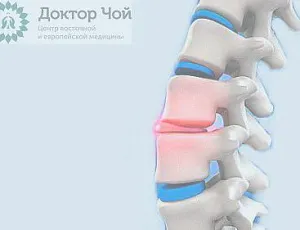 Экструзия диска. Что это такое?
