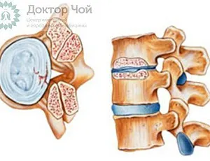 Что такое циркулярная и диффузная протрузии диска?