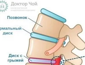 Какие виды грыж позвоночника существуют и чем они различаются?