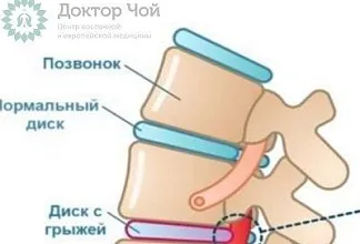 Какие виды грыж позвоночника существуют и чем они различаются?