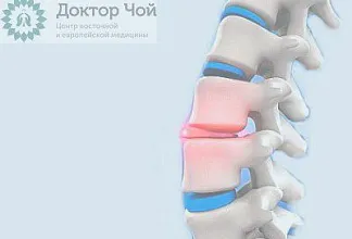 Экструзия диска. Что это такое?