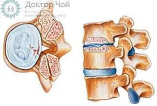 Что такое циркулярная и диффузная протрузии диска?
