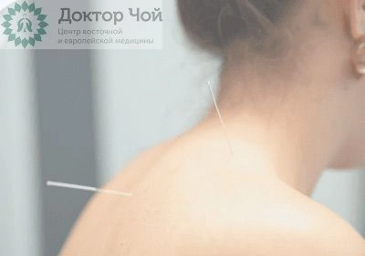 Иглорефлексотерапия шеи в Москве